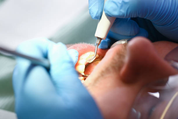 Best Chipped Tooth Repair Near Me  in Newnan, GA